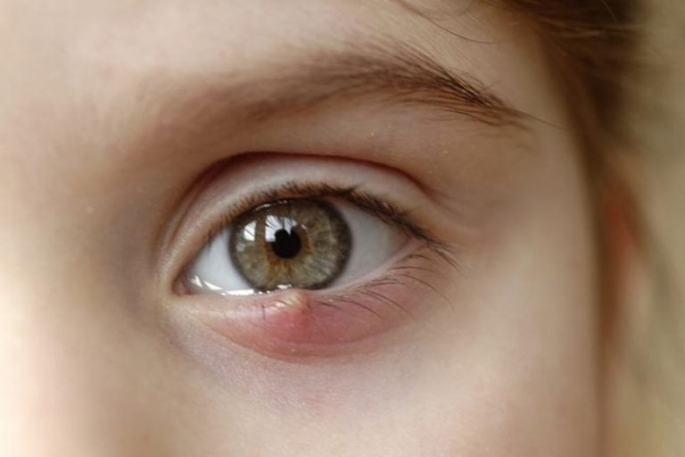 12 Cara Merawat Ketumbit Untuk Individu Yang Mengalami Blepharitis