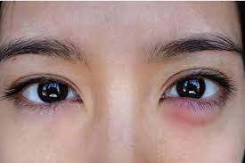 Jom Ketahui 7 Punca Mata Bengkak Yang Dihadapi Oleh Seseorang