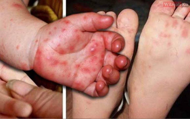 Ketahui 5 Cara Rawatan Mudah Anak Terkena HFMD