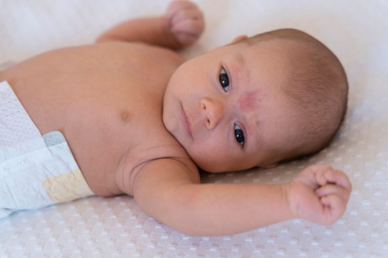 Ruam Pada Bayi: 7 Petua Semula Jadi Yang Berkesan